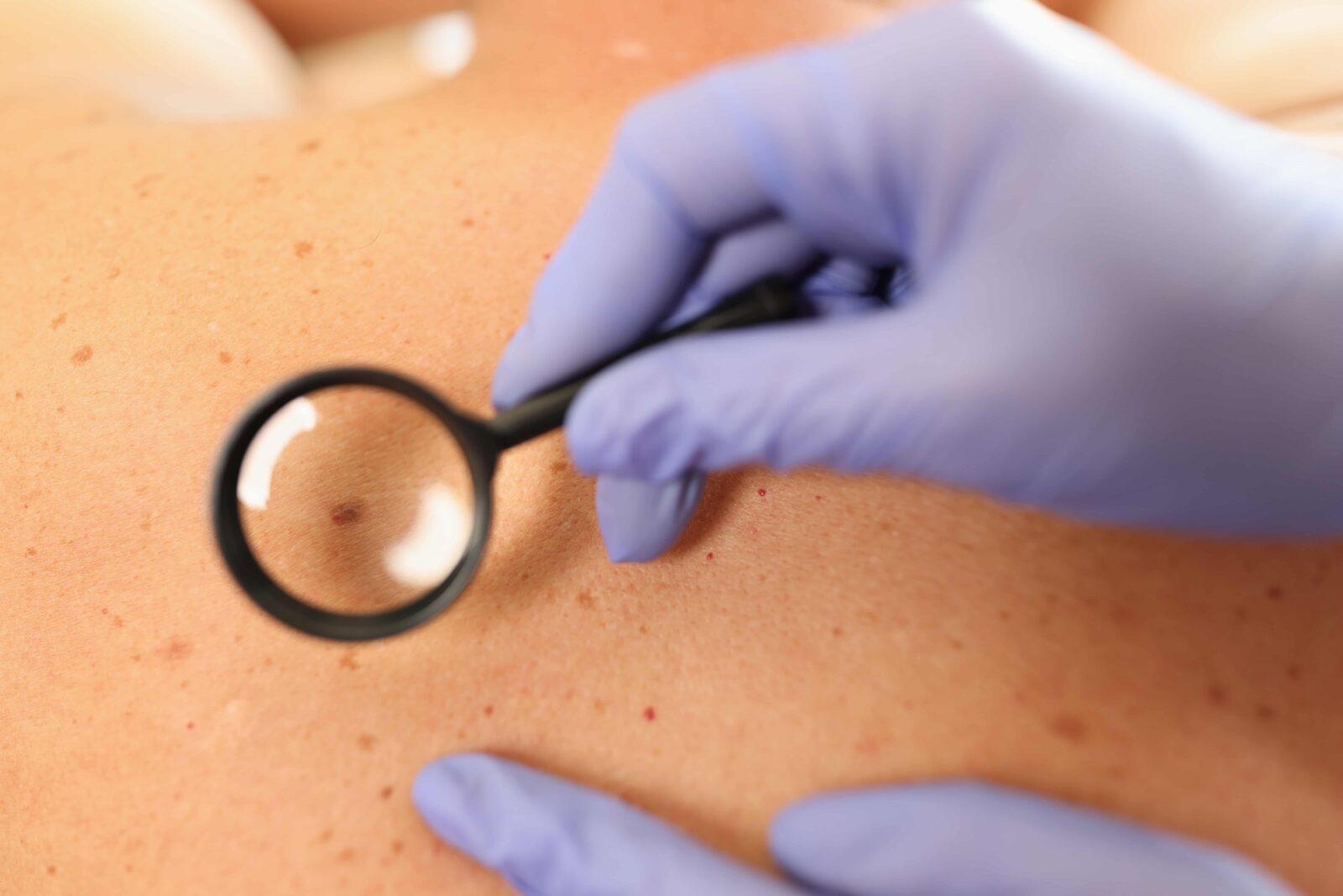 Médico dermatologista a examinar pele do paciente com dermatoscópio no Instituto Médico e Dentário Dra. Sara Martins