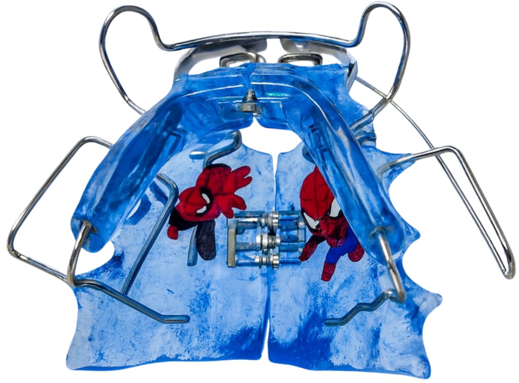 Aparelho miofuncional removível à medida em resina azul transparente com personalização Spiderman e parafuso de expansão palatina, usado em ortopedia funcional dos maxilares no Instituto Médico e Dentário Dra. Sara Martins, em Paços de Ferreira