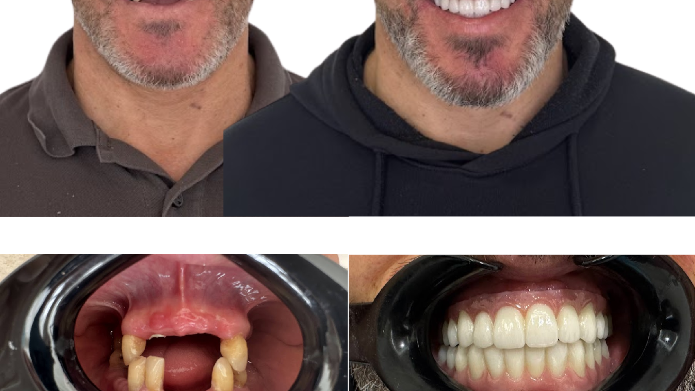 Caso clínico antes e depois de reabilitação total fixa com All-on-6 (superior) e All-on-4 (inferior), implantes Nobel Active da Nobel Biocare, no Instituto Médico e Dentário Dra. Sara Martins, em Paços de Ferreira