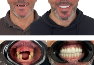 All-on-4 e All-on-6 vs implantes unitários: quando faz sentido cada solução