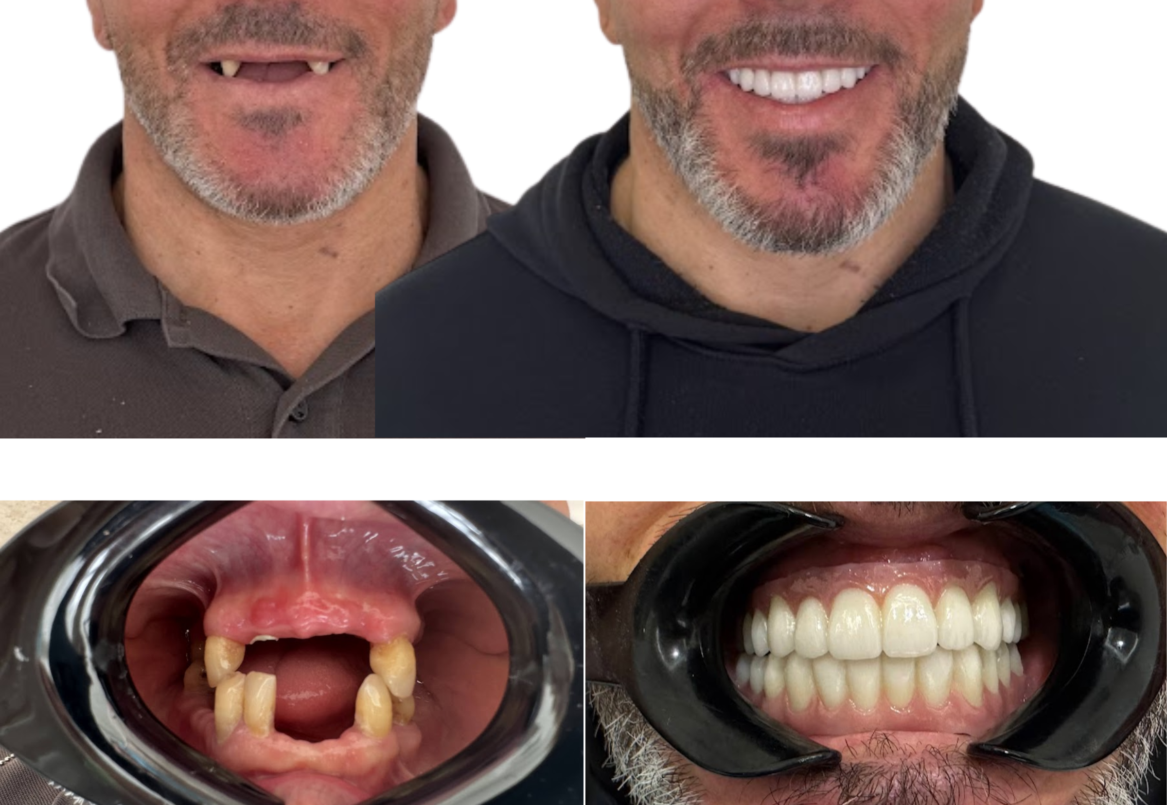 Caso clínico antes e depois de reabilitação total fixa com All-on-6 (superior) e All-on-4 (inferior), implantes Nobel Active da Nobel Biocare, no Instituto Médico e Dentário Dra. Sara Martins, em Paços de Ferreira