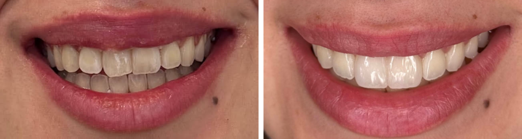 Caso clínico antes e depois de branqueamento dentário combinado com restaurações estéticas em compósito no Instituto Médico e Dentário Dra. Sara Martins, em Paços de Ferreira